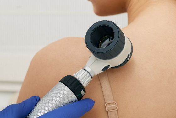 Mole dermoscopy. Physician check-up of a patient's skin with a dermatoscopy for prevention of melanoma and skin cancer, close-up.